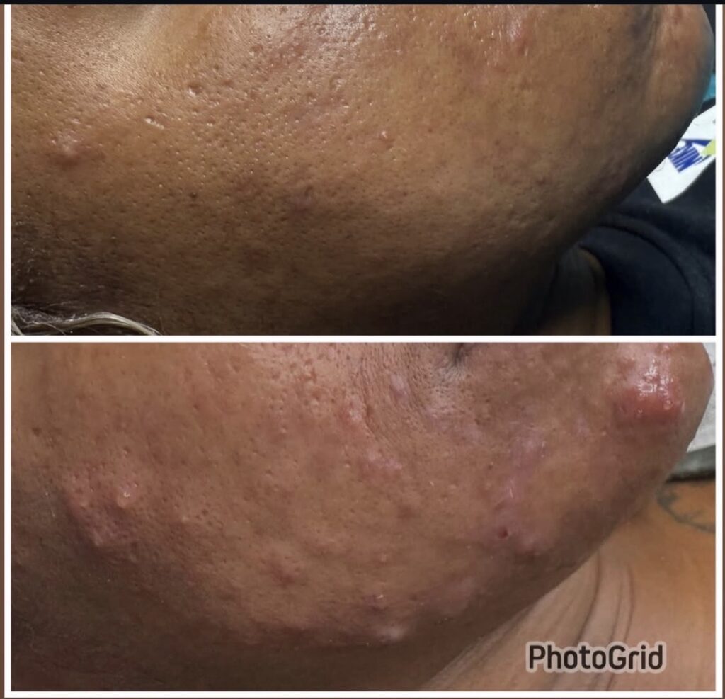 Acne Treatment