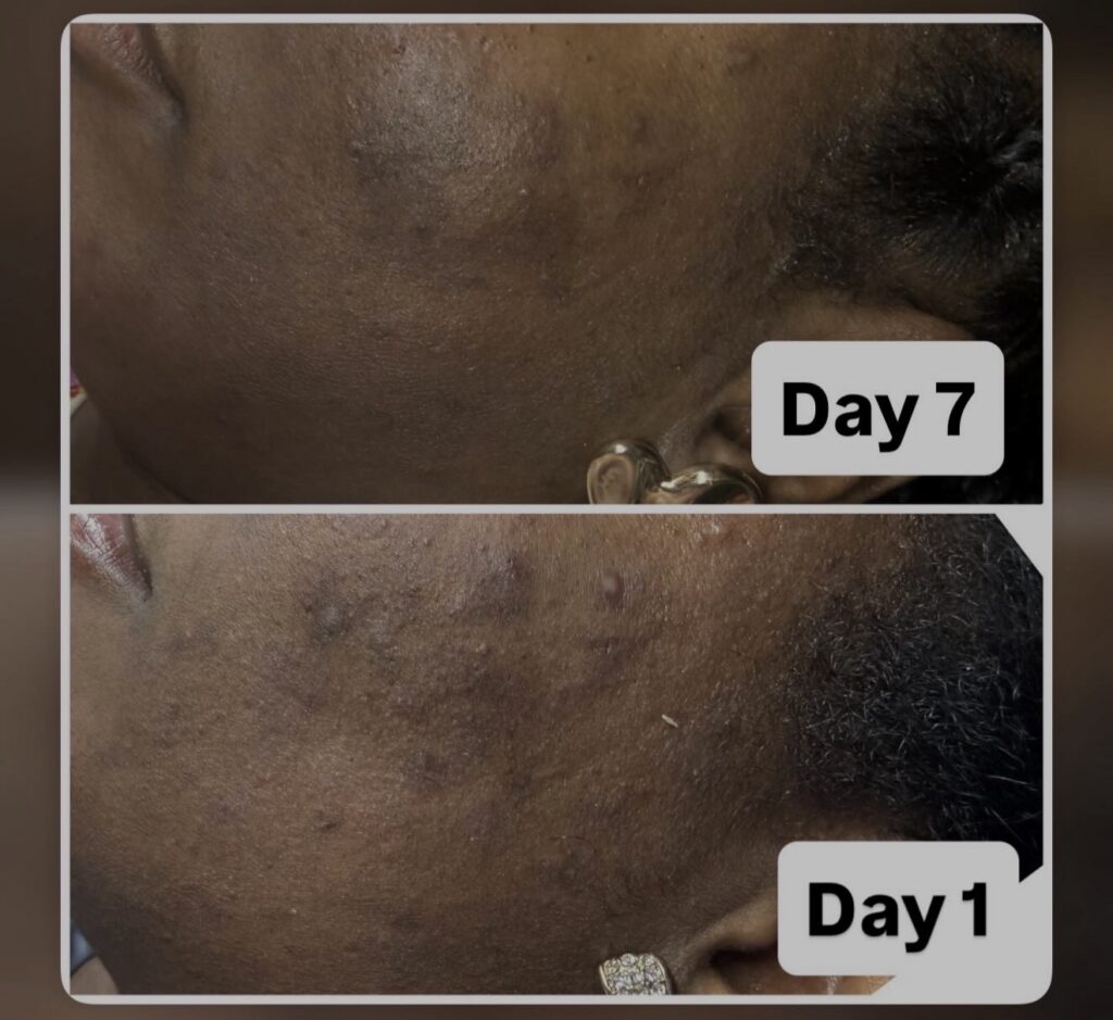 Herbal Peels — client transformation