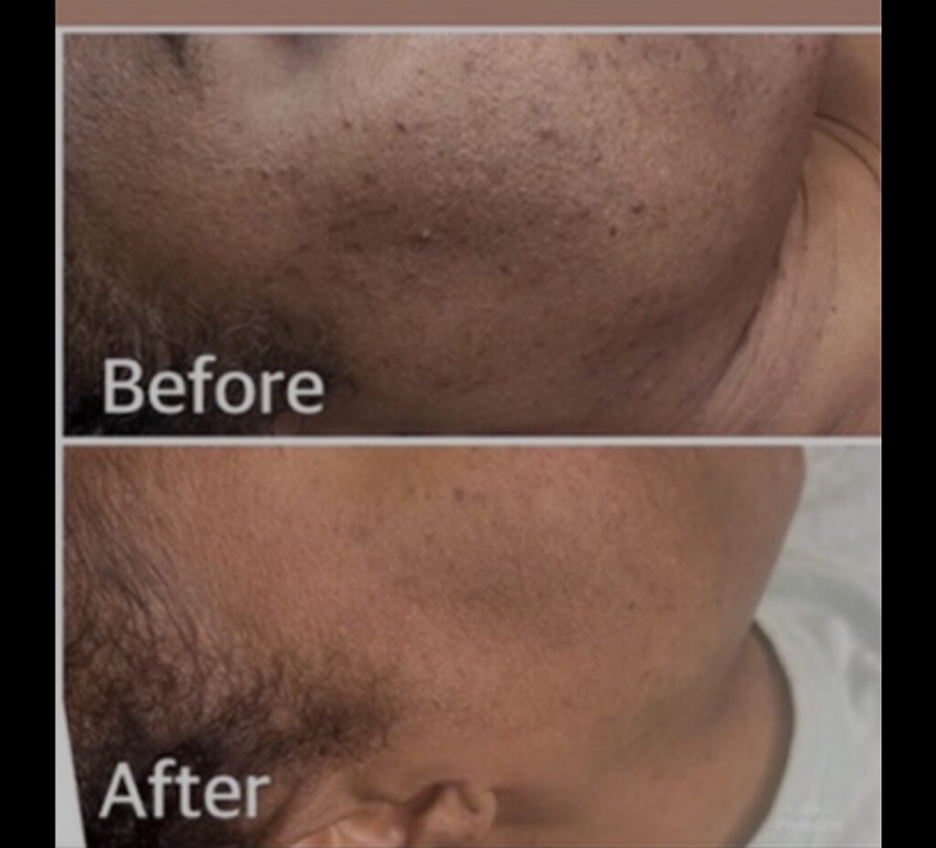 Herbal Peels — client transformation