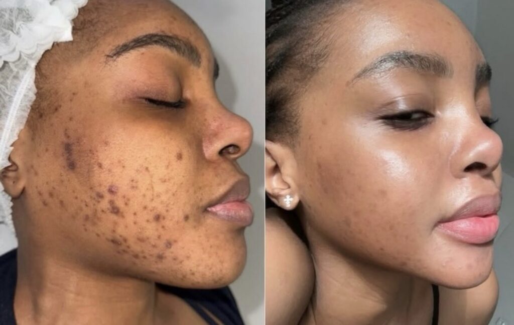 Advanced Herbal Peels — client transformation