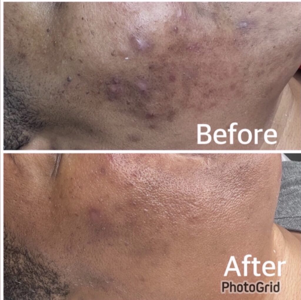 Herbal Peels — client transformation