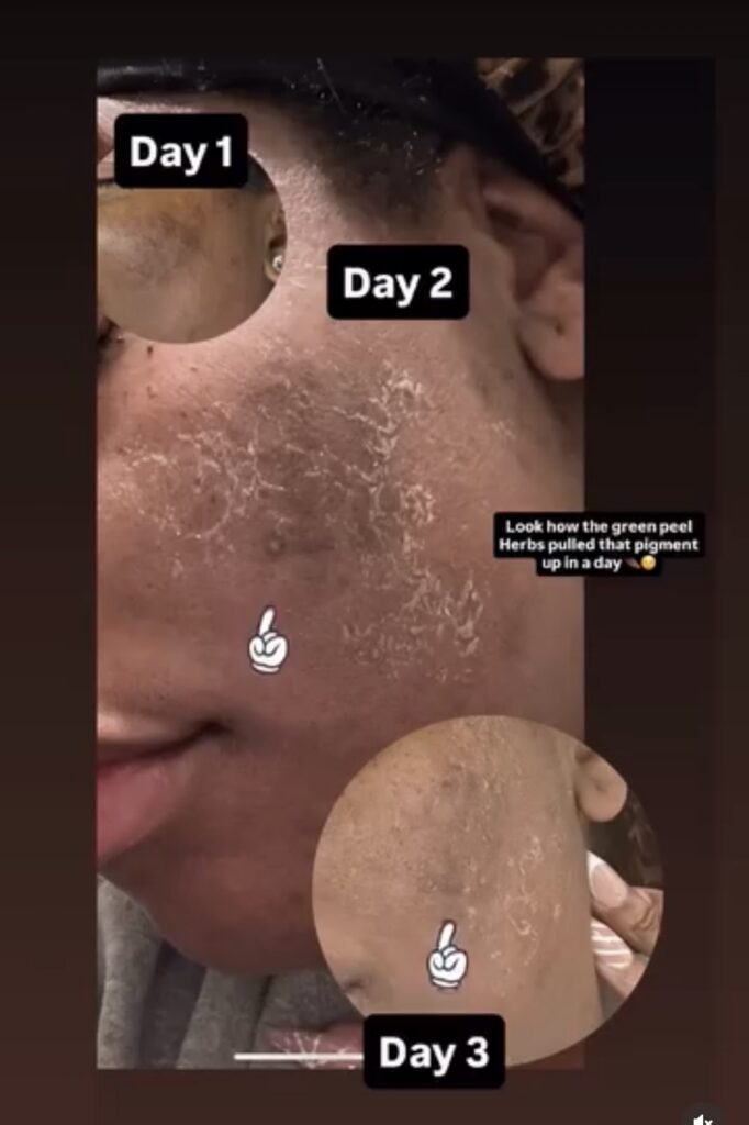Advanced Herbal Peel · Treatment Progress — client progress