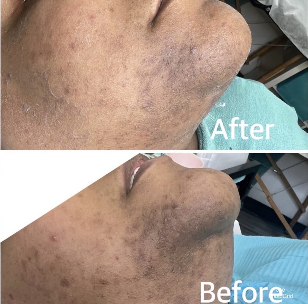 Herbal Peels — client transformation