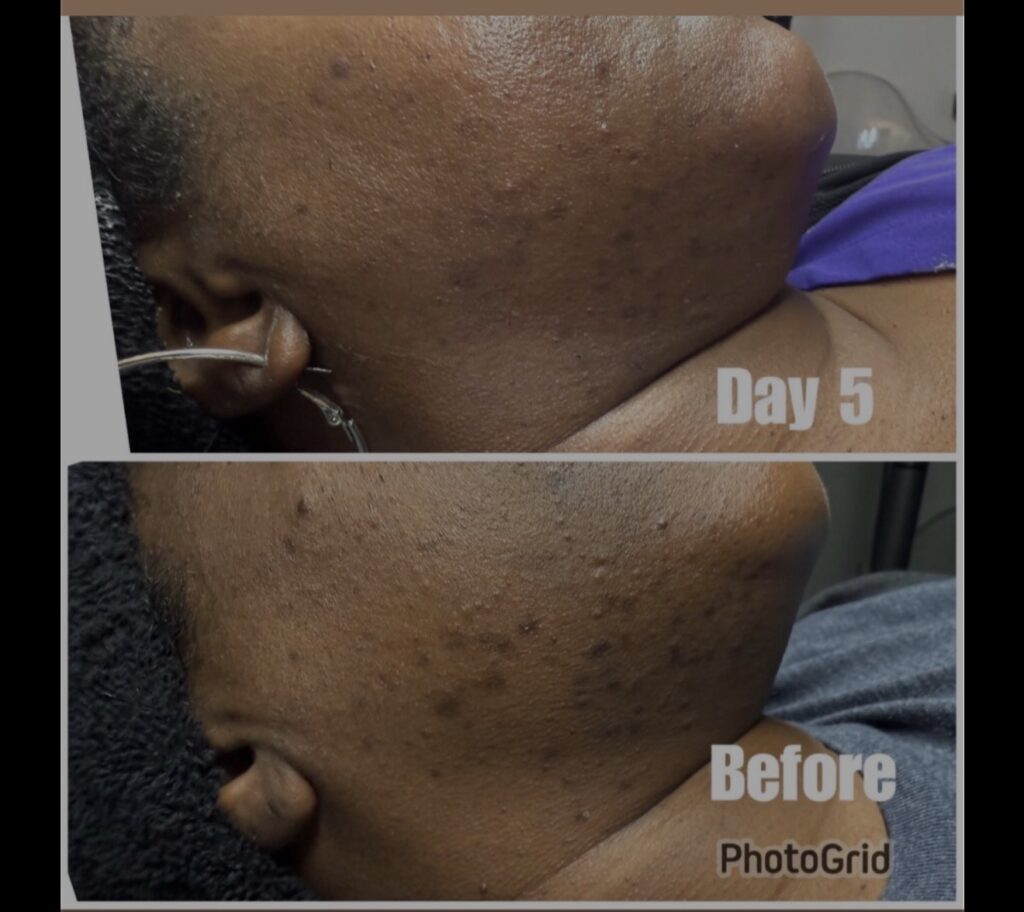 Advanced Herbal Peel — before and day five