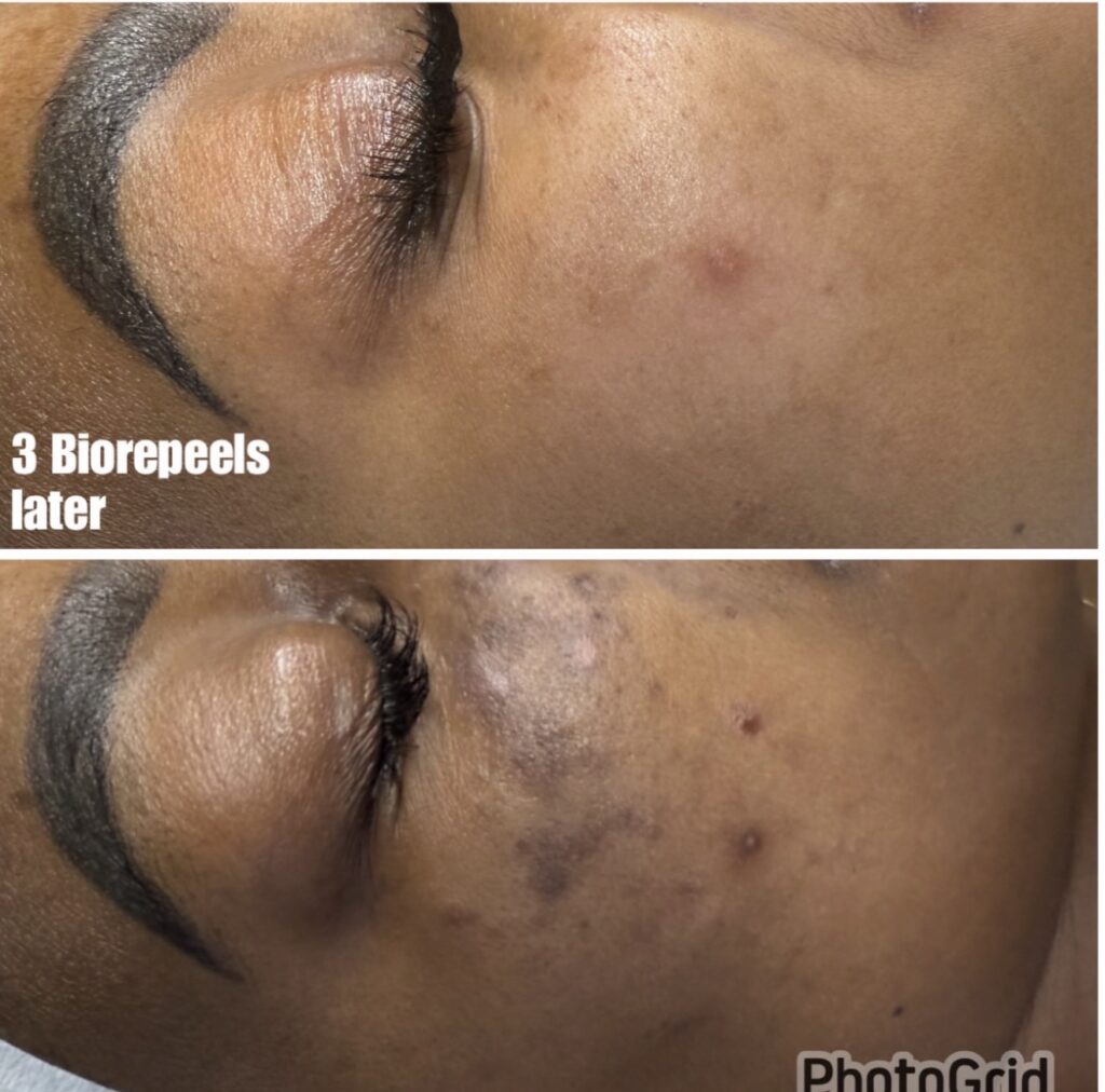 BioRePeel — client progress