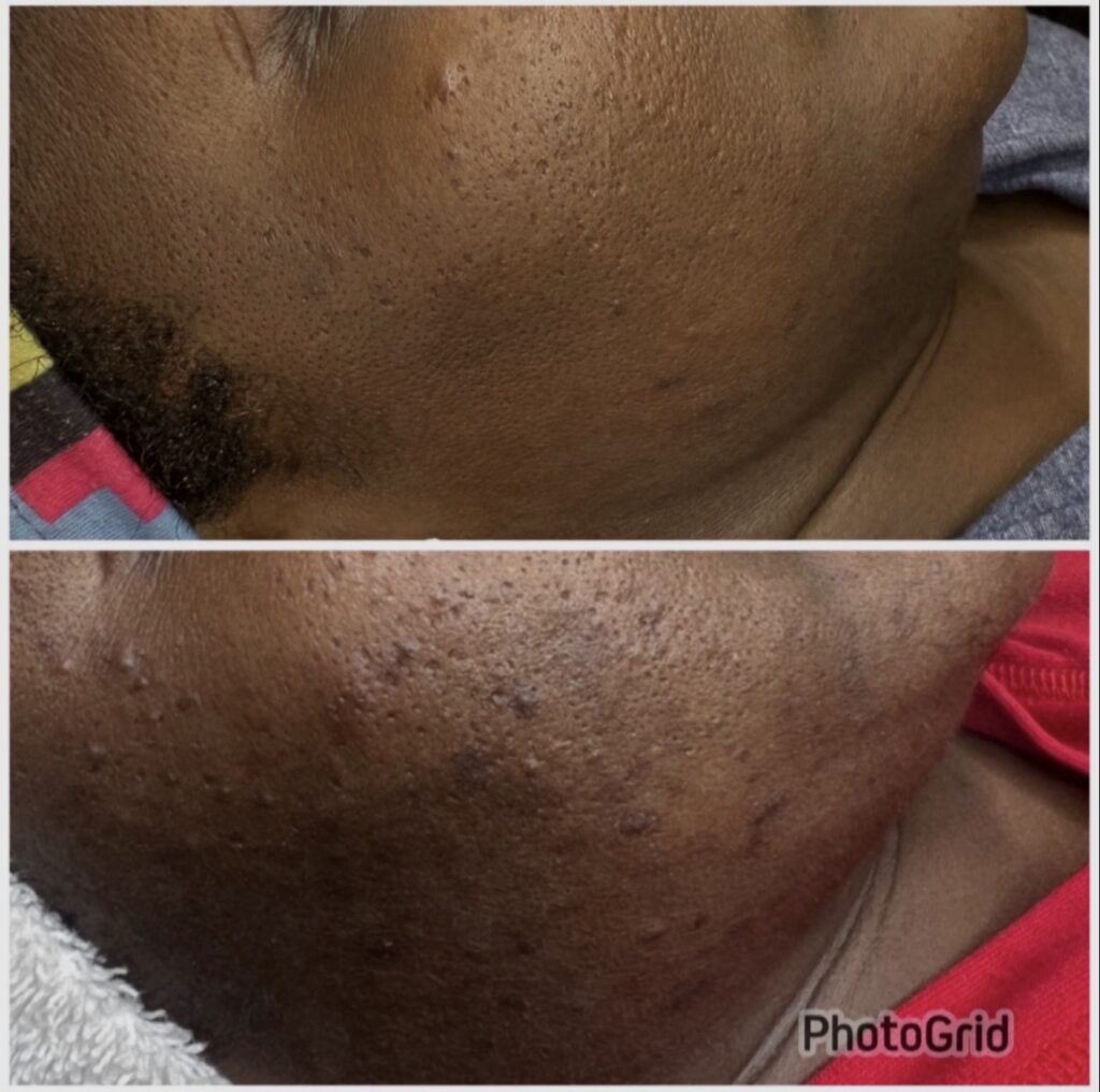 Advanced Herbal Peel client transformation