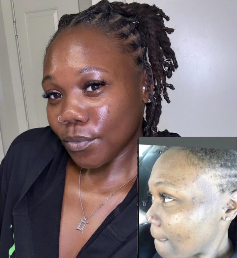 Herbal Peels + Microneedling — Jae