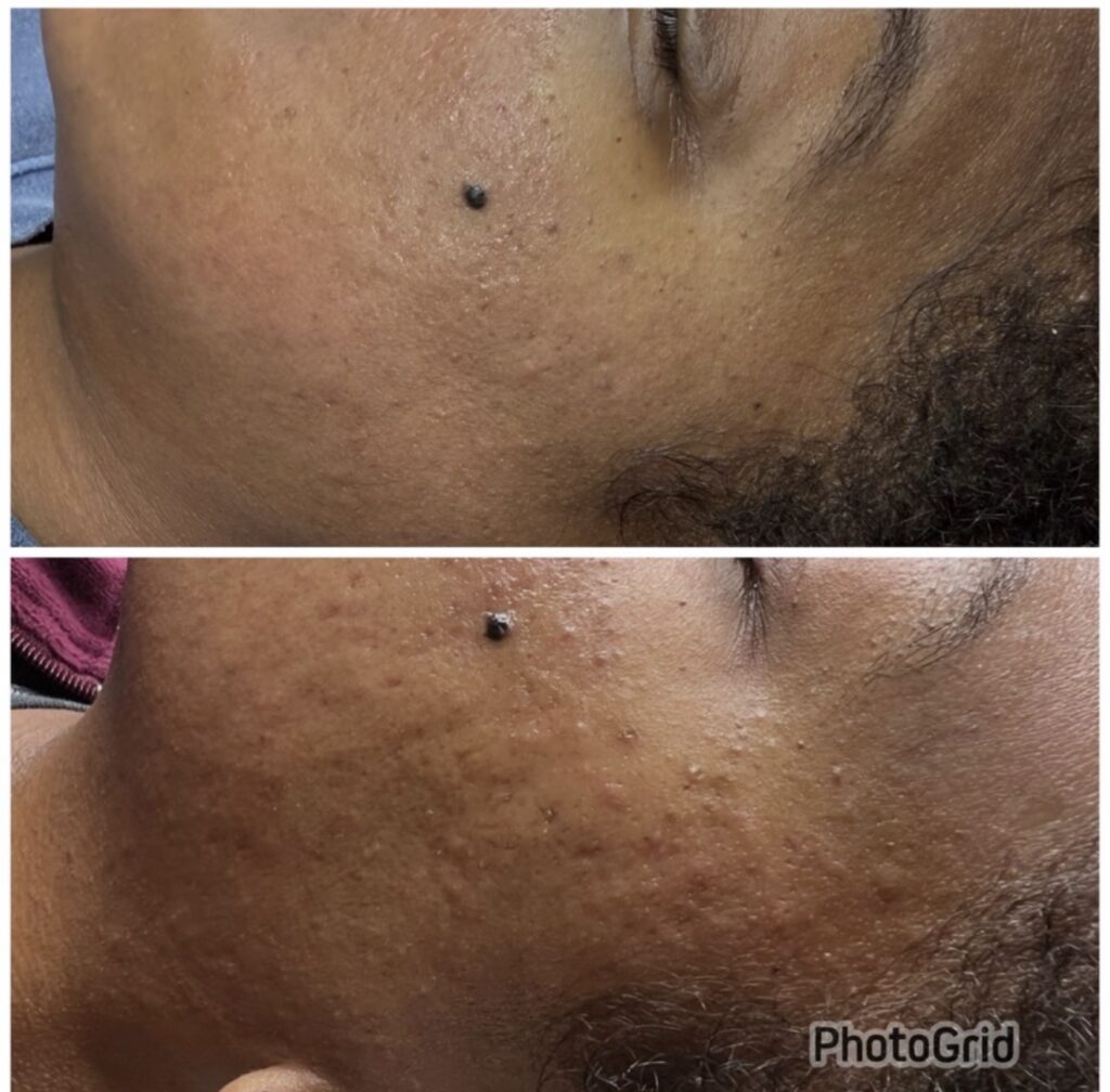 Microneedling before and after, client with mole and skin texture