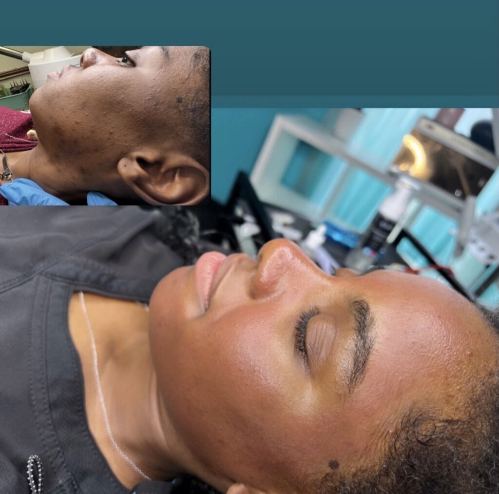 Facials & Peels client transformation
